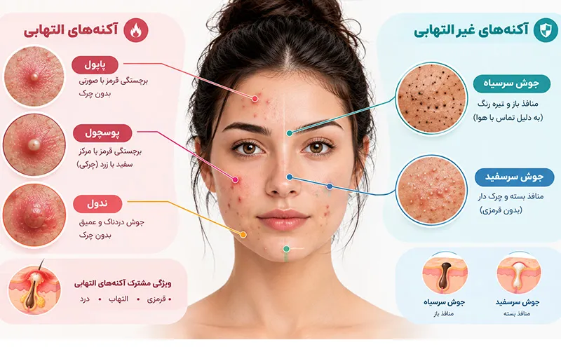 انواع جوش های صورت